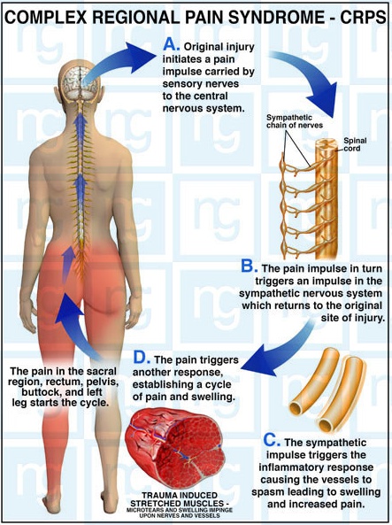 CRPS(պı).jpg